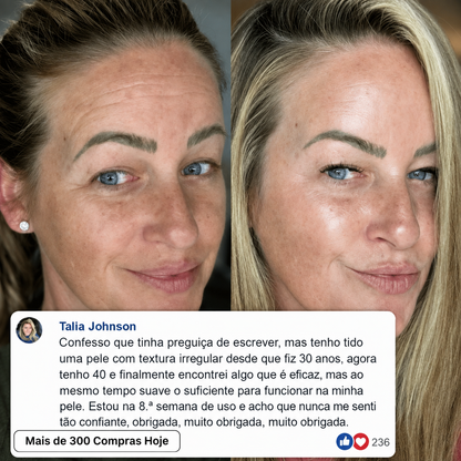 Transforme Rugas, Linhas Finas e Vincos de Expressão Cansados de Forma Natural